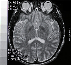 brain